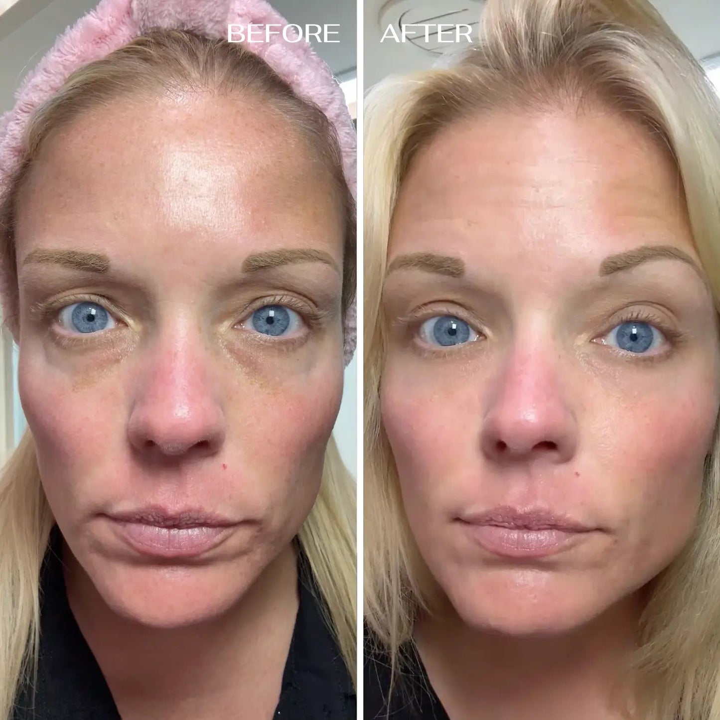 🔥Final 3 Hours : Only Limited Stock Left💖ALL-IN-ONE BALM FOR UNDER-EYE RENEWAL